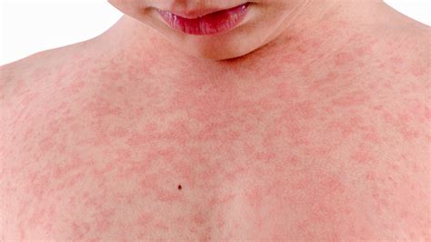 can you get a rash on your face from a cold