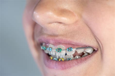 can you get braces while missing a tooth