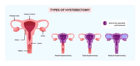 can you get cervical cancer after a hysterectomy