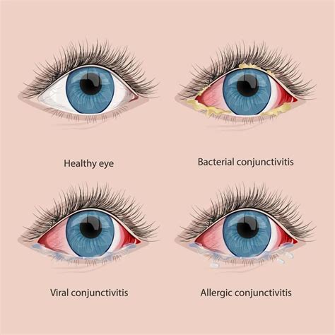 can you get conjunctivitis from getting something in your eye