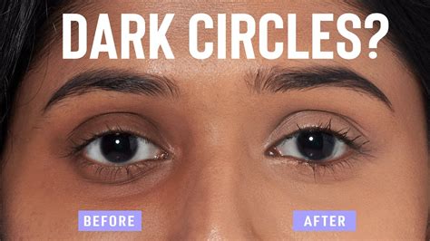 can you get dark circles from crying