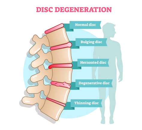 can you get disability for degenerative disc disease