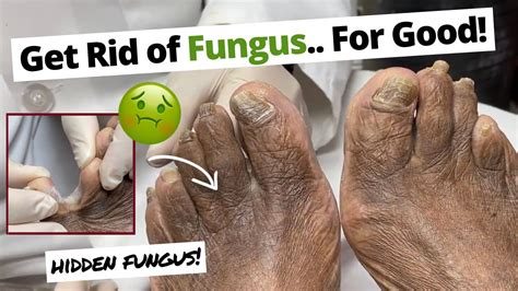 Can You Get Foot Fungus From Used Shoes