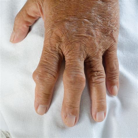 can you get gout in the hands