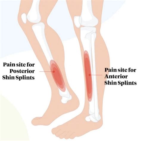 Can You Get Shin Splints In The Back Of Your Calf