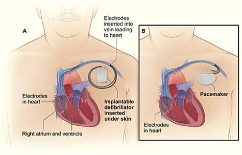 can you have both a pacemaker and a defibrillator