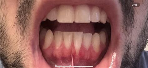 NHS dentists who rake in £690k pa are paid five times PM's salary