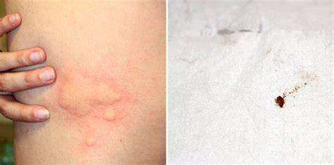 Can You Have One Bed Bug Bite