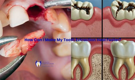 Can You Put A Tooth Back In After Extraction