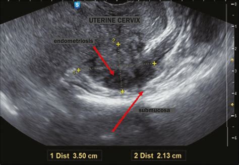 can you see endometriosis on imaging