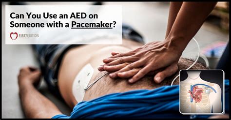 Can You Use Aed With Pacemaker