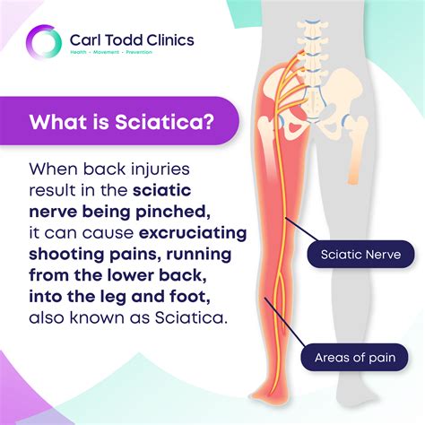 Can cervical spine cause sciatica?