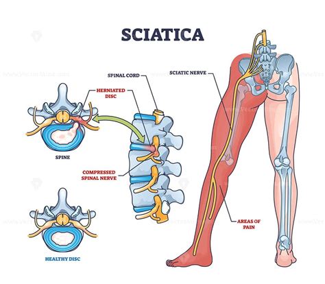 Can uneven hips cause sciatica?