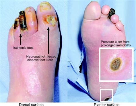 cancellous bone diabetic foot ulcer