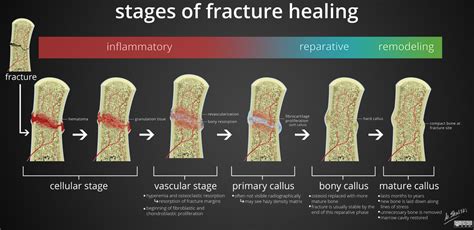 cancellous bone fracture healing