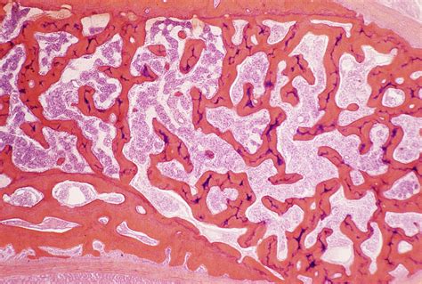 cancellous bone under microscope