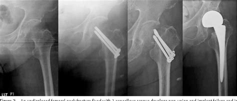 cancellous screw fixation