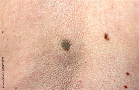 cancer black spot on skin