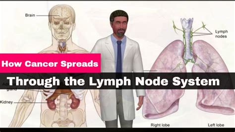 cancer cells in lymph nodes prognosis