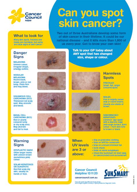 cancer council melanoma guidelines