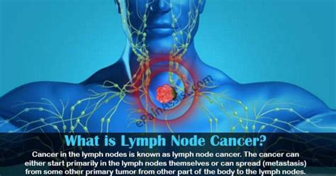 cancer in the lymph nodes prognosis