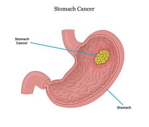 cancerous tumor in the stomach