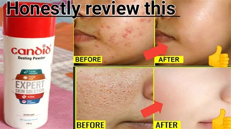 Candid Dusting Powder Benefits