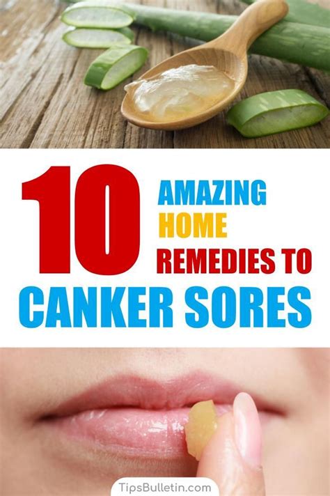 Natural and Effective 9 Canker Sore Remedies That Work Fast Canker