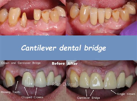 Cantilever Bridge Teeth