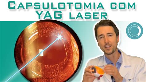 capsulotomia yag laser effetti collaterali