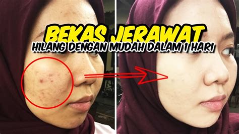 Cara Ampuh Mengatasi Jerawat Dan Bekasnya