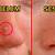 cara menghilangkan bekas jerawat di hidung