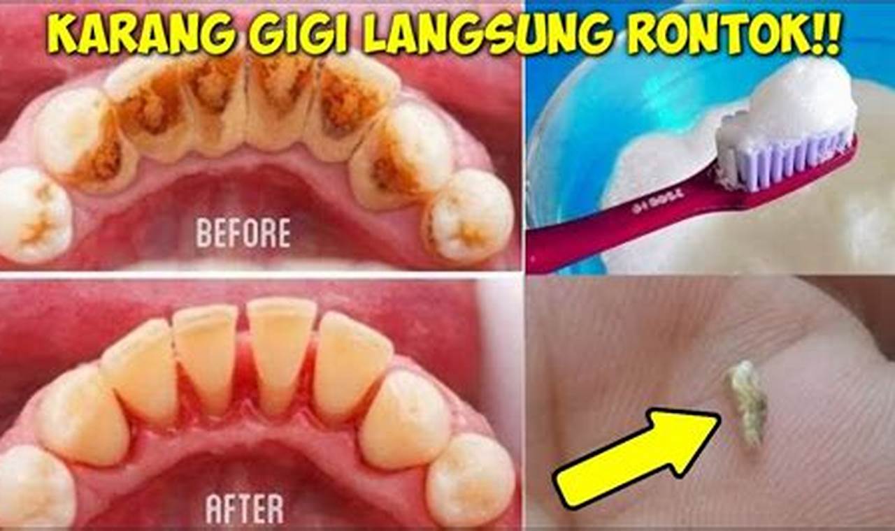 Solusi Ampuh Hilangkan Karang Gigi, Temukan Rahasia Dahsyat di Sini!