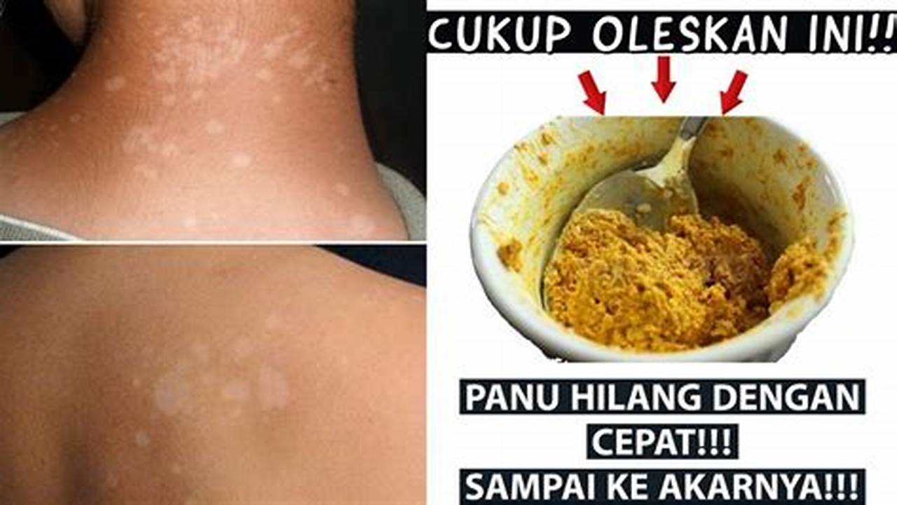 Cara Ampuh Hilangkan Panu Sampai ke Akarnya