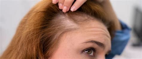 Rahasia Terungkap: Solusi Ampuh untuk Menumbuhkan Rambut yang Pitak!