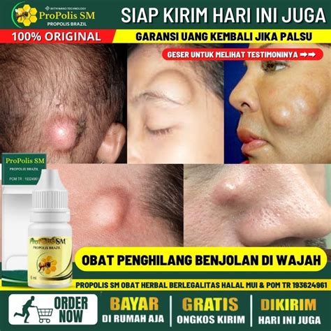 Cara Mengatasi Benjolan Di Wajah Seperti Jerawat