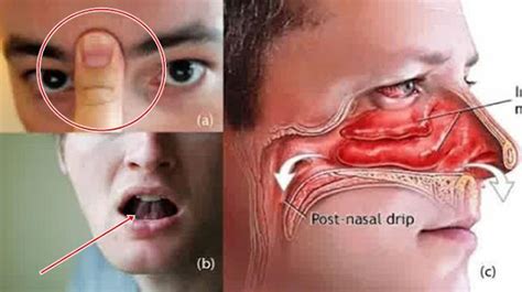 cara mengatasi hidung mampet sebelah akibat deviasi septum hidung