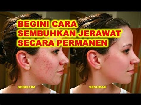 Cara Mengatasi Jerawat Dengan Odol