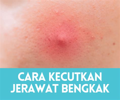 Cara Mengatasi Jerawat Membengkak