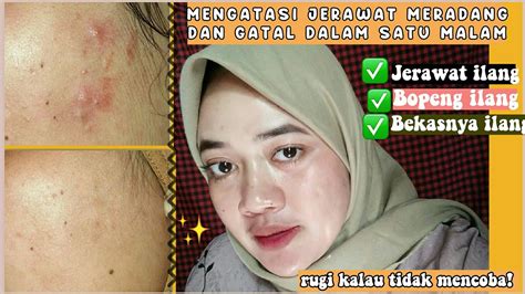 Cara Mengatasi Jerawat Meradang Di Jidat