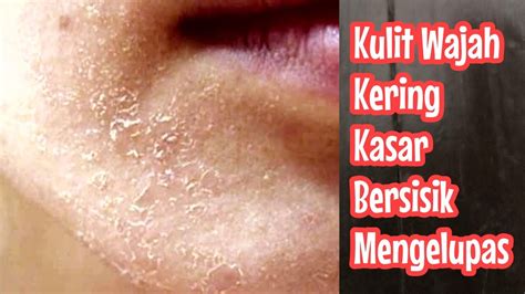 11 Cara Mengatasi Kulit Kering Agar Tetap Lembap, Sehat, dan Kenyal