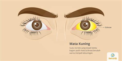 Cara mengatasi mata kuning dengan menghindari faktor pemicu