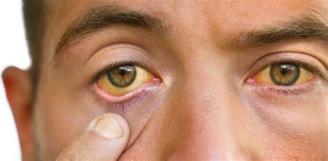 Cara mengatasi mata kuning dengan terapi alternatif
