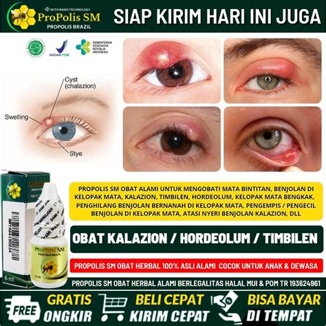 cara mengatasi mata timbilan in Indonesia