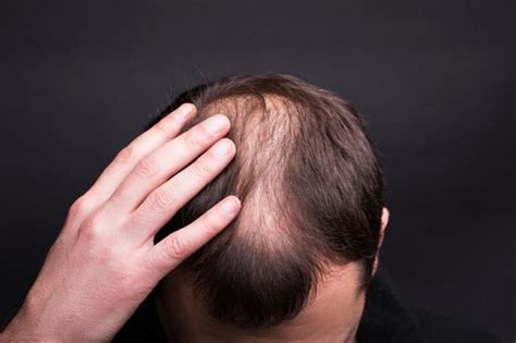 Atasi Rambut Rontok Pria: Solusi Terbukti dan Wawasan Terkini