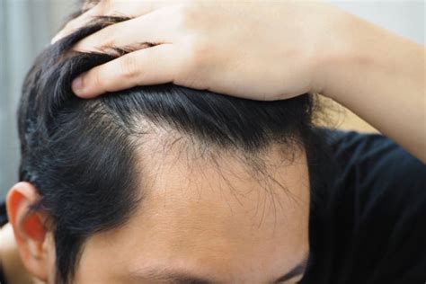 Cara Mengatasi Rambut Rontok dan Tidak Tumbuh: Solusi Ampuh untuk Masalah Rambut Anda