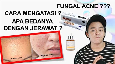 Cara Menghilangkan Jerawat Fungal Acne