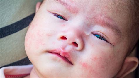 cara menghindari pemicu alergi kulit