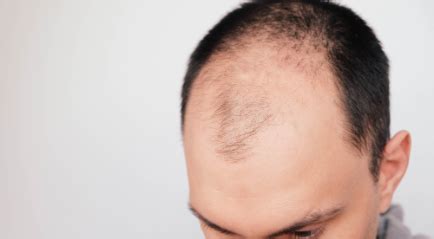 Rahasia Menumbuhkan Rambut Botak Bagian Depan yang Terbukti Ampuh