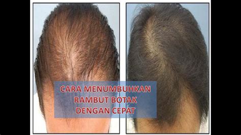 Rahasia Terbaru Menumbuhkan Rambut Botak dengan Kilat!